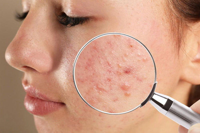 Charmadala (Acne & Skin Infections)